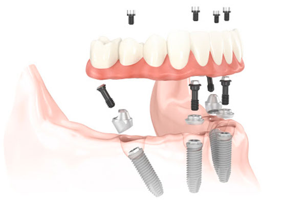 Prótesis Dental Fija