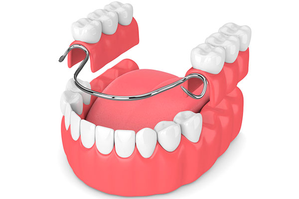 Prótesis Dental Removible