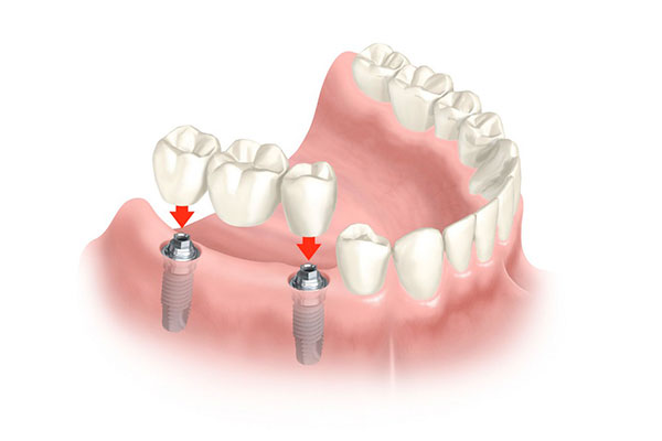 Prótesis Dental en Puente