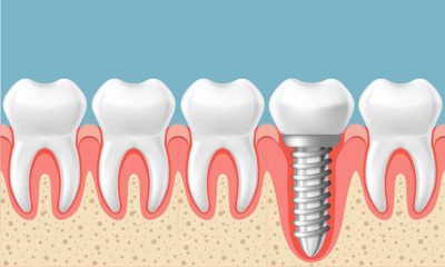 Qué es un Implante Dental