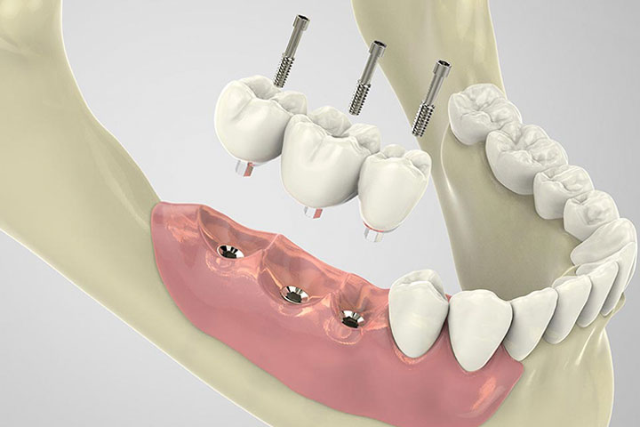 Riesgos de Implantes de baja calidad