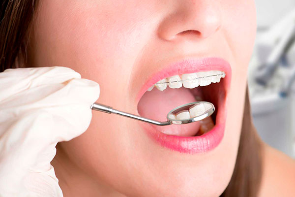Tipos de Brackets